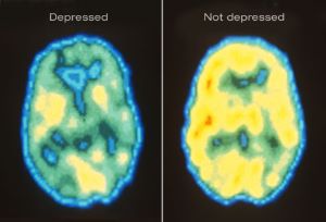 Depressed brain scan 